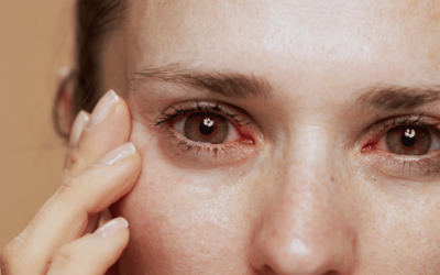 Can Neurolens Help with My Dry Eyes?