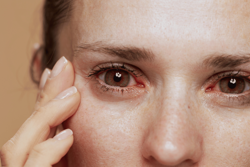 close-up on a woman with irritated, red eyes