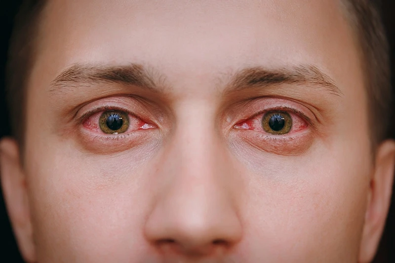 Spotting Pink Eye Early: What to Look for and How to Treat It