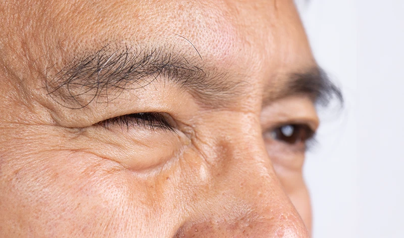 Eye Twitching: Why It Happens and When to See a Doctor
