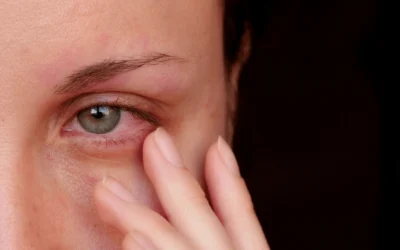 Dry Eye or Allergies? How to Tell the Difference