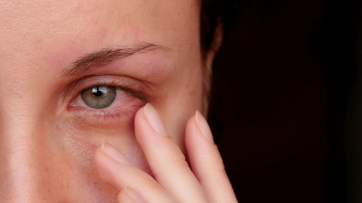 red_eye_dry_eye_or_allergies close-up of red eye